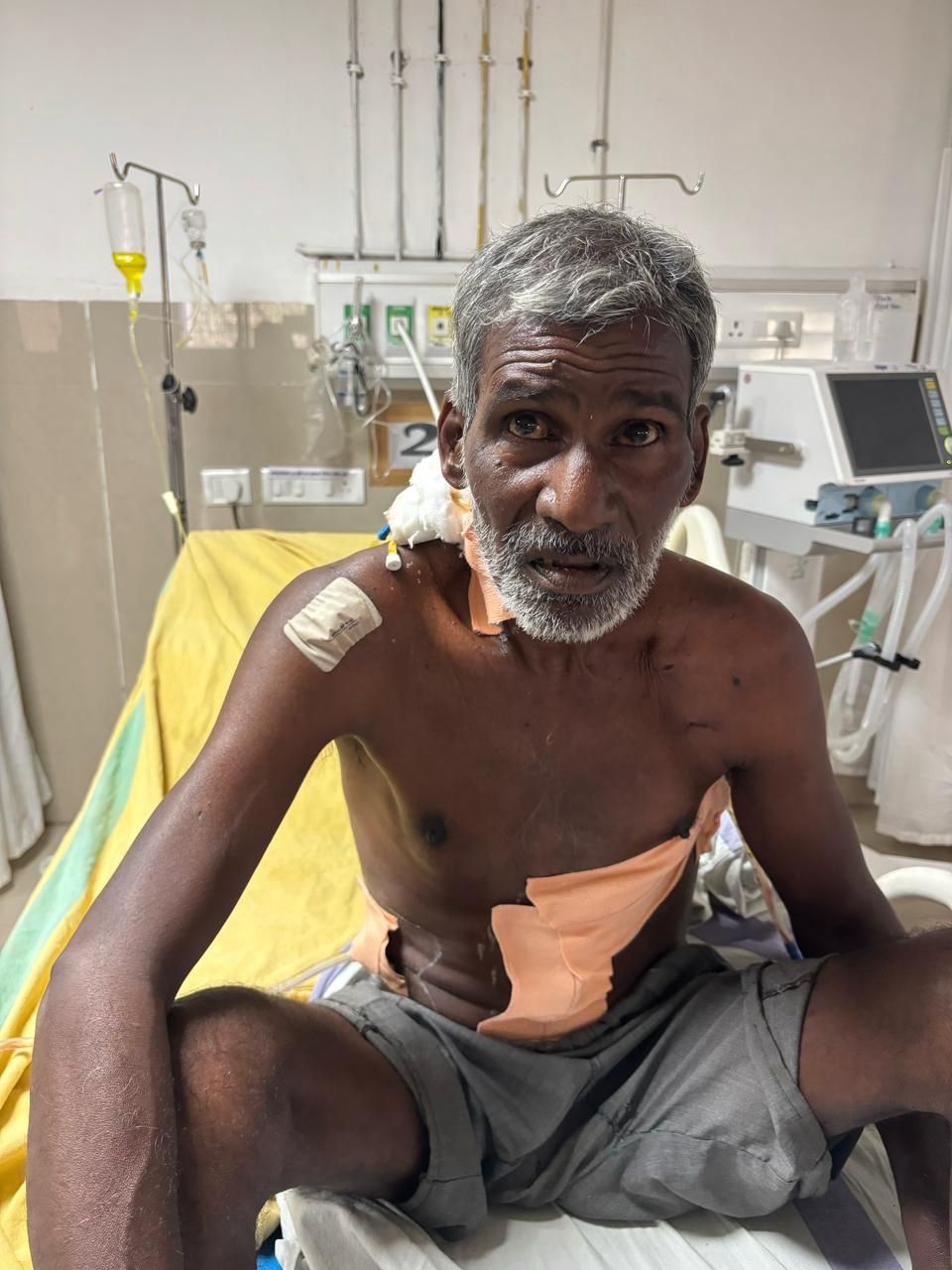 सड़क दुर्घटना में गंभीर रूप से घायल मोहन राणा का मेडिकल कॉलेज रायगढ़ में हुआ सफल ऑपरेशन ट्रक दुर्घटना के बाद उनके बाएं छाती और बायी पेट पर लगी थी गंभीर चोट सफल ऑपरेशन के बाद डॉक्टरों की देख-रेख में सर्जरी रोग विभाग में भती है मरीज